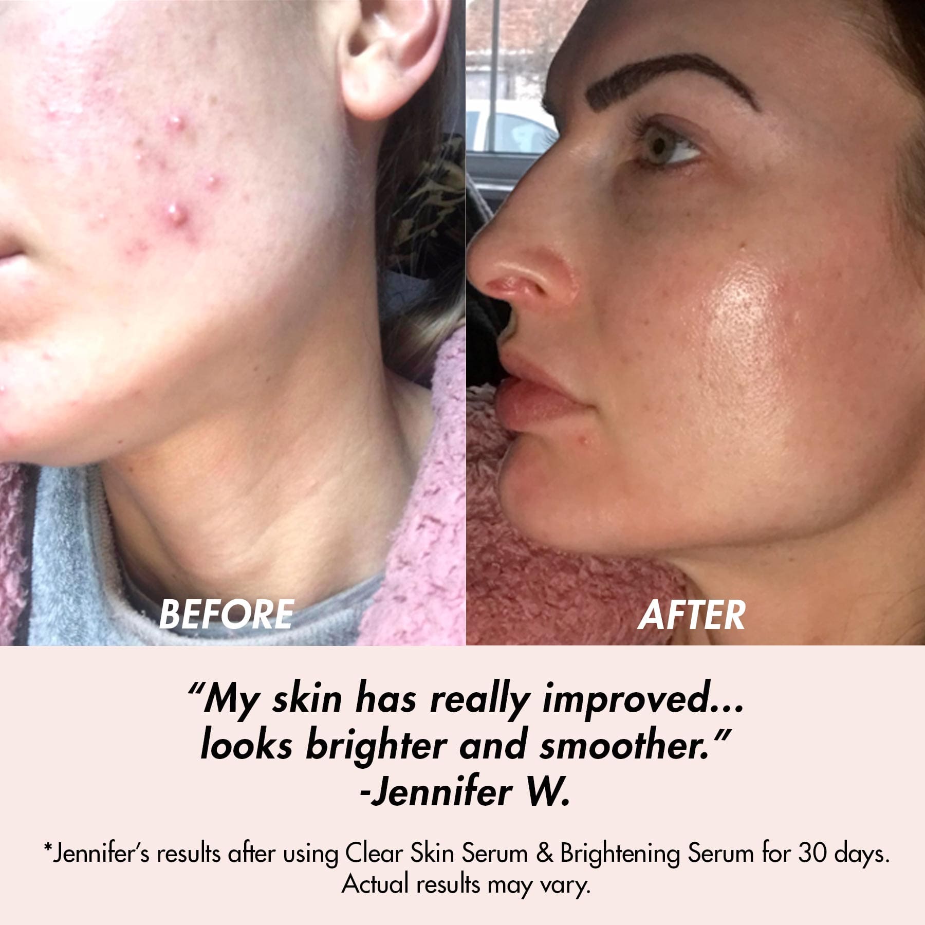 Clear Skin Serum | Natural Skin Care Bundle | Results | Before & After | Customer Review Jennifer | Awake Organics